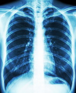 Carcinoma polmonare a cellule squamose, da Chmp ok per afatinib